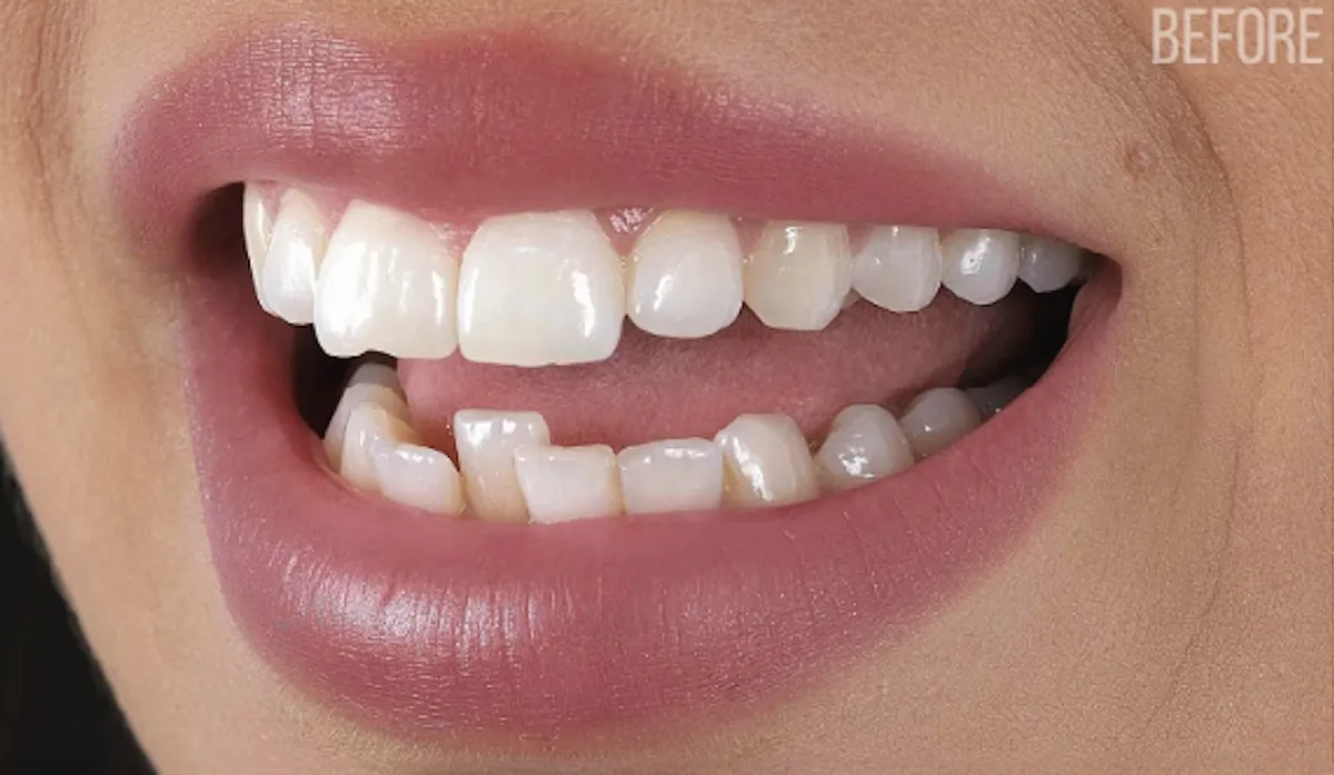 Before veneers