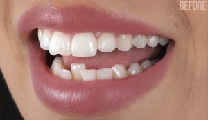 Before dental veneers near Niles