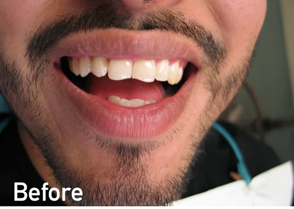 Before dental bonding near Evanston