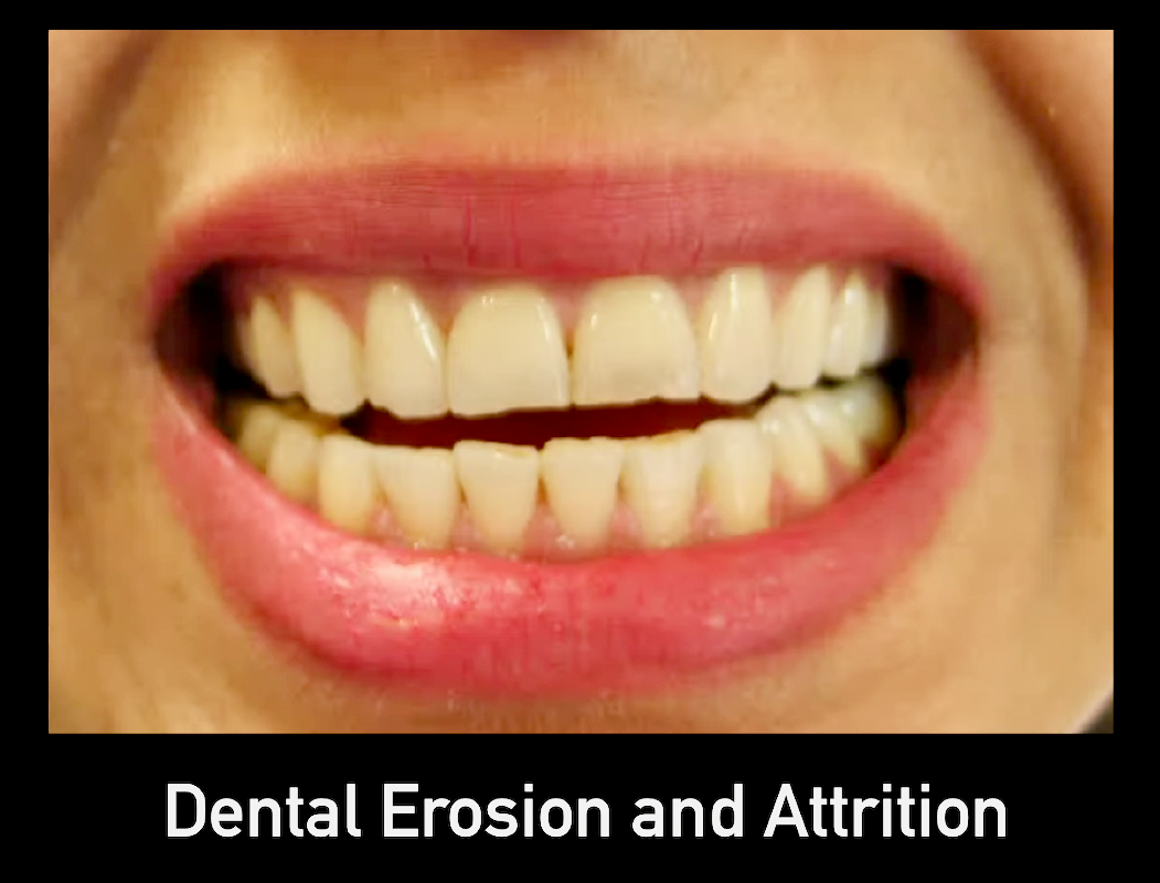 Tooth erosion and attrition