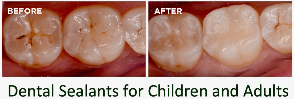 Dental Sealants for Children and Adults