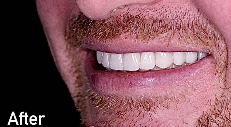 After dental bridge treatment in Morton Grove