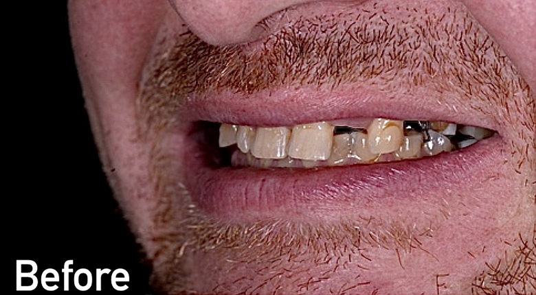 Before dental bridge treatment in Morton Grove