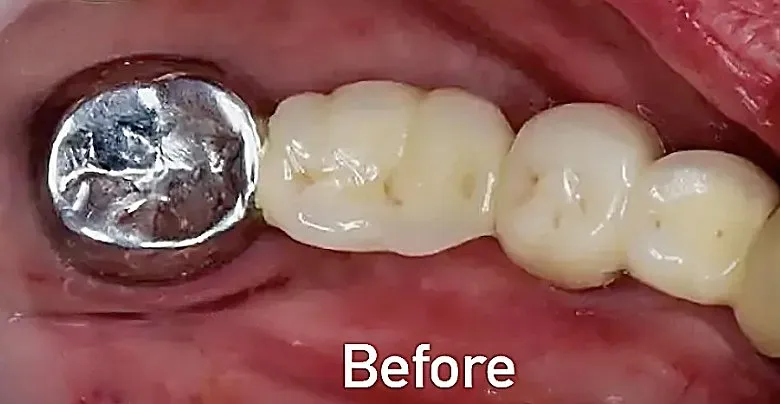 Before dental bridge