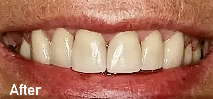 Abrasion after restoration