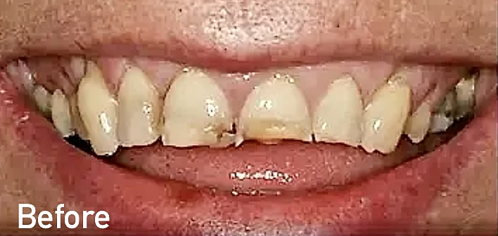 Abrasion before treatment