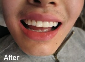 Eric after enameloplasty at ProCare Family Dental &mdash; smooth, even tooth edges