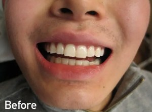Eric before enameloplasty &mdash; uneven front-tooth edges