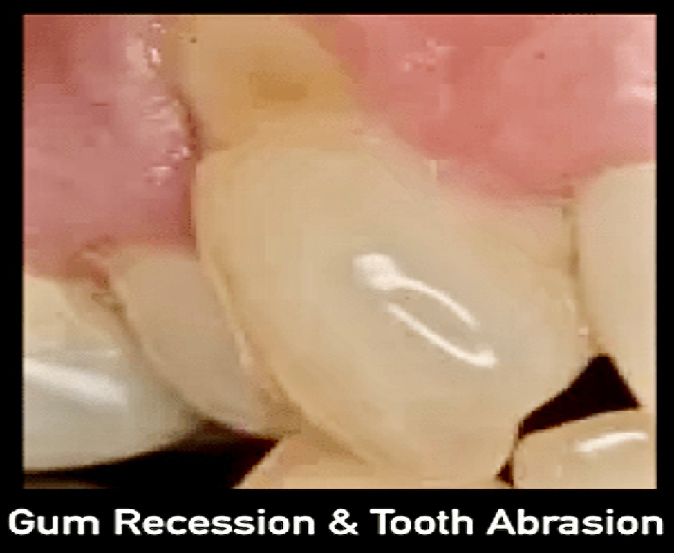 Gum recession causing tooth sensitivity