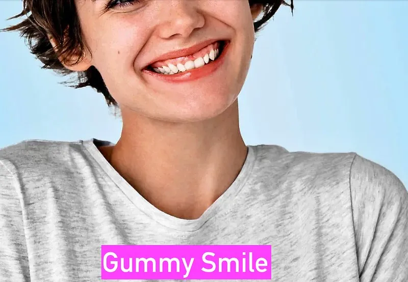 Before gummy smile treatment showing excessive gum display