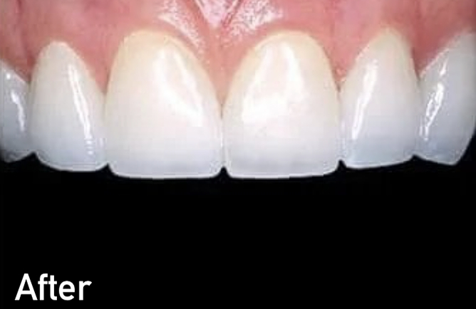 After porcelain veneers