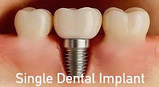 Single tooth dental implant in Morton Grove, IL