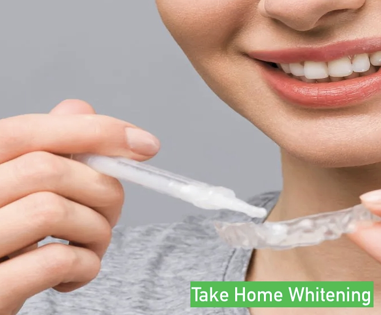 Custom take-home whitening trays from ProCare Family Dental in Morton Grove