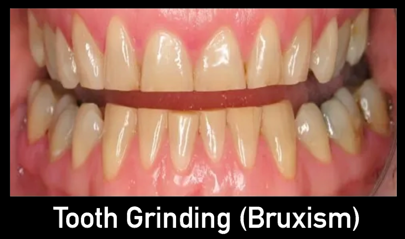 Teeth grinding bruxism