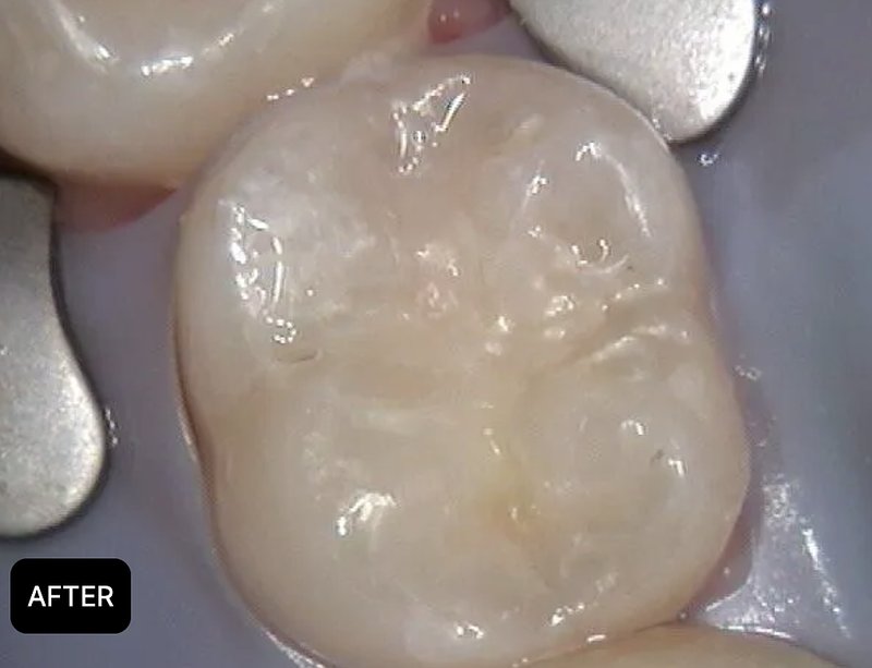 After treatment image showing protected molar surface and tooth-colored filling in Morton Grove