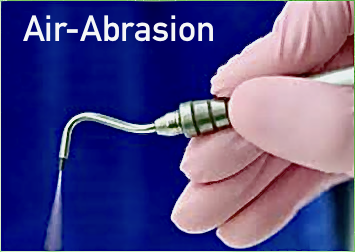 air-abrasion