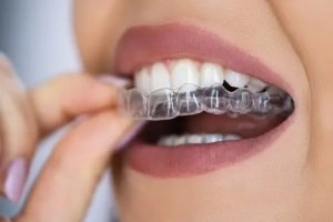 Clear aligners Invisalign
