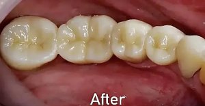 Restored dental bridge after treatment in Morton Grove