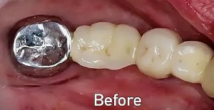 Before dental bridge with metal crown in Morton Grove
