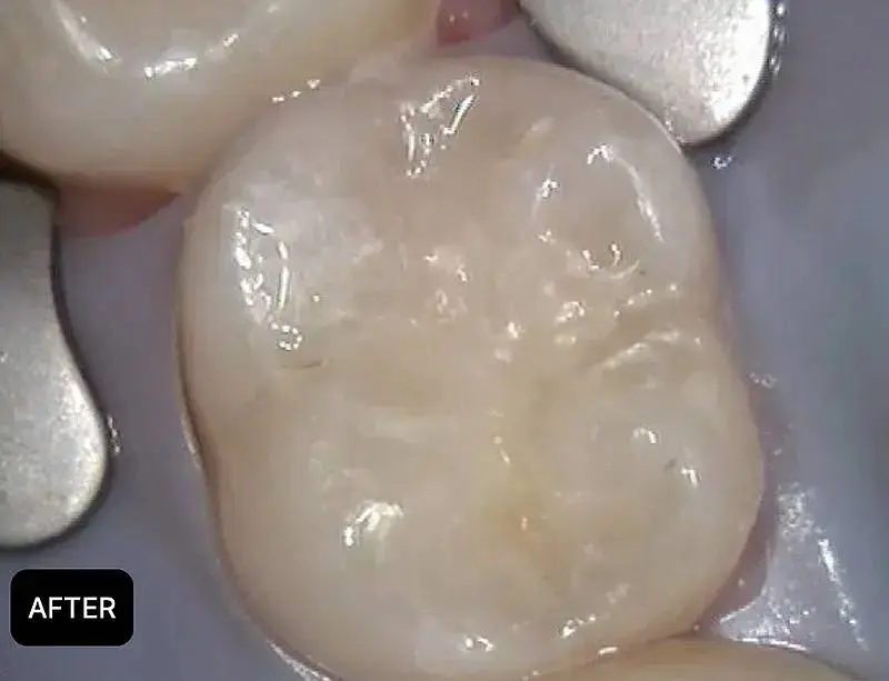 Tooth-colored dental filling result at ProCare Family Dental in Morton Grove