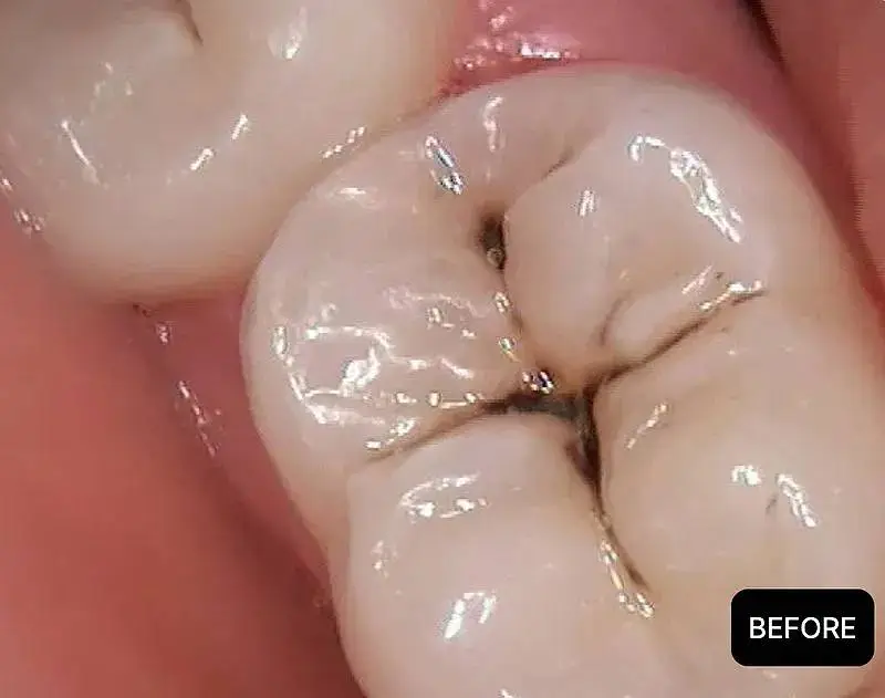 Tooth decay before dental filling at ProCare Family Dental in Morton Grove