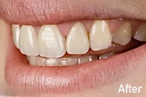 Emily’s dental crown transformation in Morton Grove showing improved smile after porcelain crown placement by Dr. Penelope Danos
