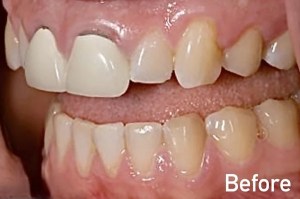 Before dental crowns treatment in Morton Grove showing uneven and discolored front teeth