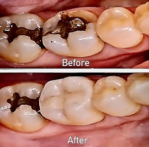 Before and after white dental fillings in Morton Grove