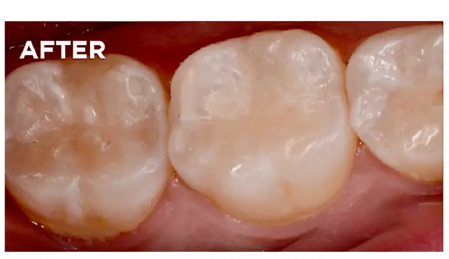 After dental sealants applied to protect molars from cavities at ProCare Family Dental in Morton Grove