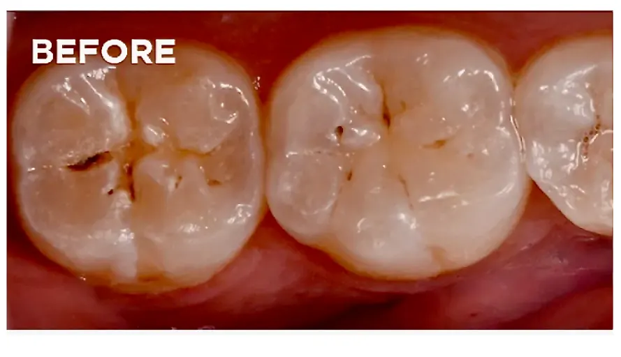 Before dental sealants showing deep grooves on molars at ProCare Family Dental in Morton Grove