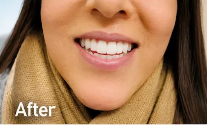 After braces in Morton Grove showing straight aligned and brighter smile