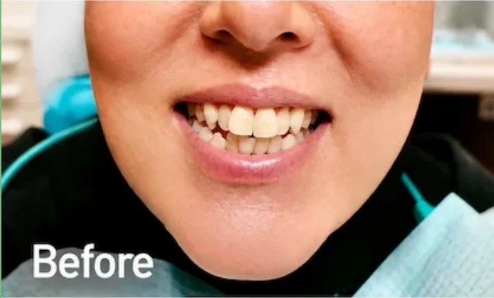 Before braces in Morton Grove showing crowded and misaligned teeth