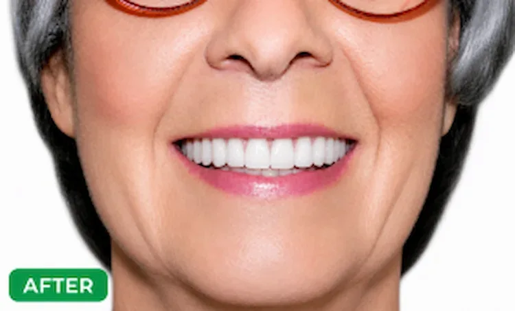 After denture treatment showing natural looking dentures and improved smile in Morton Grove patient