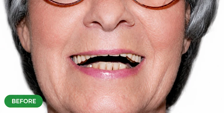 Before denture treatment showing worn uneven teeth and gaps in Morton Grove patient
