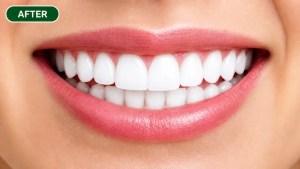 After teeth whitening showing brighter, whiter smile in Morton Grove patient