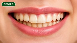 Before teeth whitening showing yellow and stained teeth in Morton Grove patient