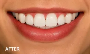 After white spot dental treatment showing smoother brighter front teeth