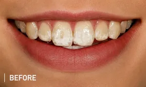 Before white spot dental treatment showing enamel discoloration on front teeth