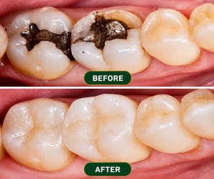 Before and after dental filling replacement showing removal of metal fillings and natural tooth-colored restorations in Morton Grove IL