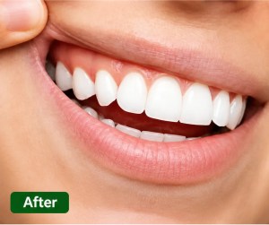 After periodontal treatment showing healthier gums and reduced inflammation in Morton Grove patient