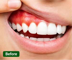 Before periodontal treatment showing inflamed gums and signs of gum disease in Morton Grove patient