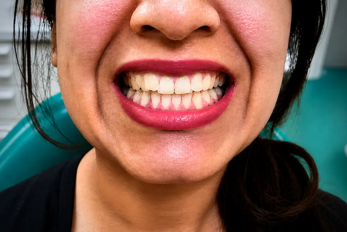 Before orthodontic treatment showing uneven and discolored teeth in Morton Grove dental patient