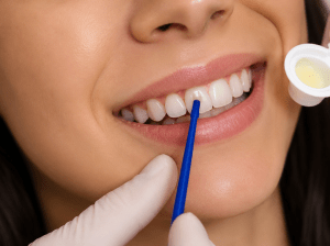 Close-up of fluoride varnish being applied to an adult patient's teeth during a preventive dental visit at ProCare Family Dental in Morton Grove, Illinois.