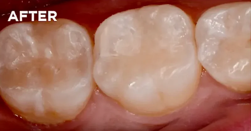 After dental sealants applied to molars, sealing deep grooves and pits to help prevent cavities and protect tooth enamel.