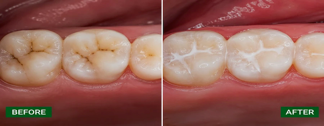 Before and after close-up of molars showing dental sealants protecting deep grooves from cavities at ProCare Family Dental in Morton Grove, Illinois.