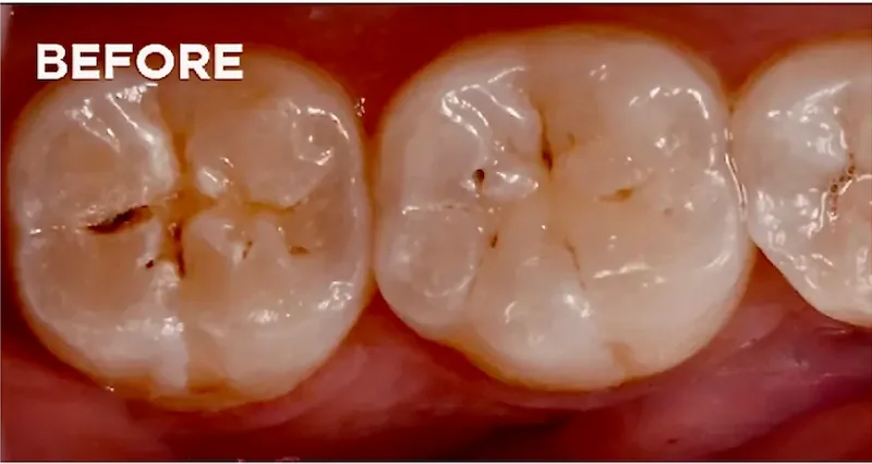 Before dental sealants showing deep grooves and pits on molars where plaque and cavity-causing bacteria can collect.