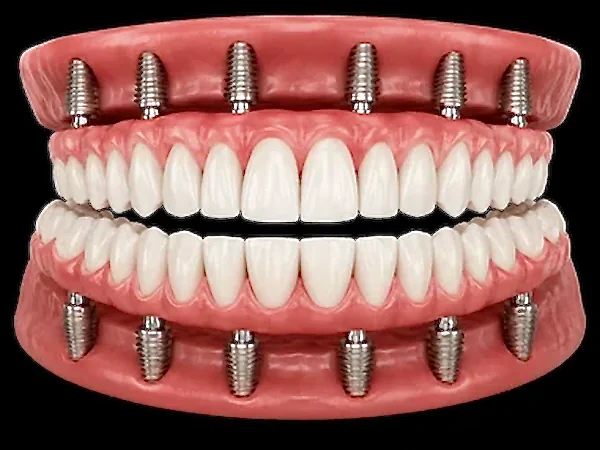 3D illustration of fixed full-arch dental implants supporting a complete upper and lower arch of replacement teeth at ProCare Family Dental in Morton Grove, Illinois.