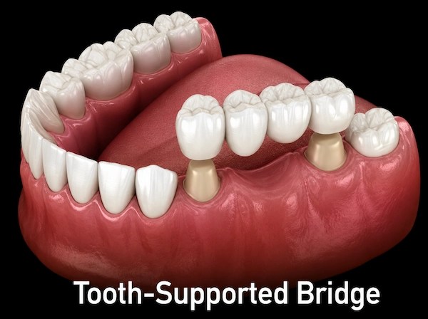 3D illustration of a traditional tooth-supported dental bridge replacing multiple missing teeth using adjacent natural teeth for support at ProCare Family Dental in Morton Grove, Illinois.