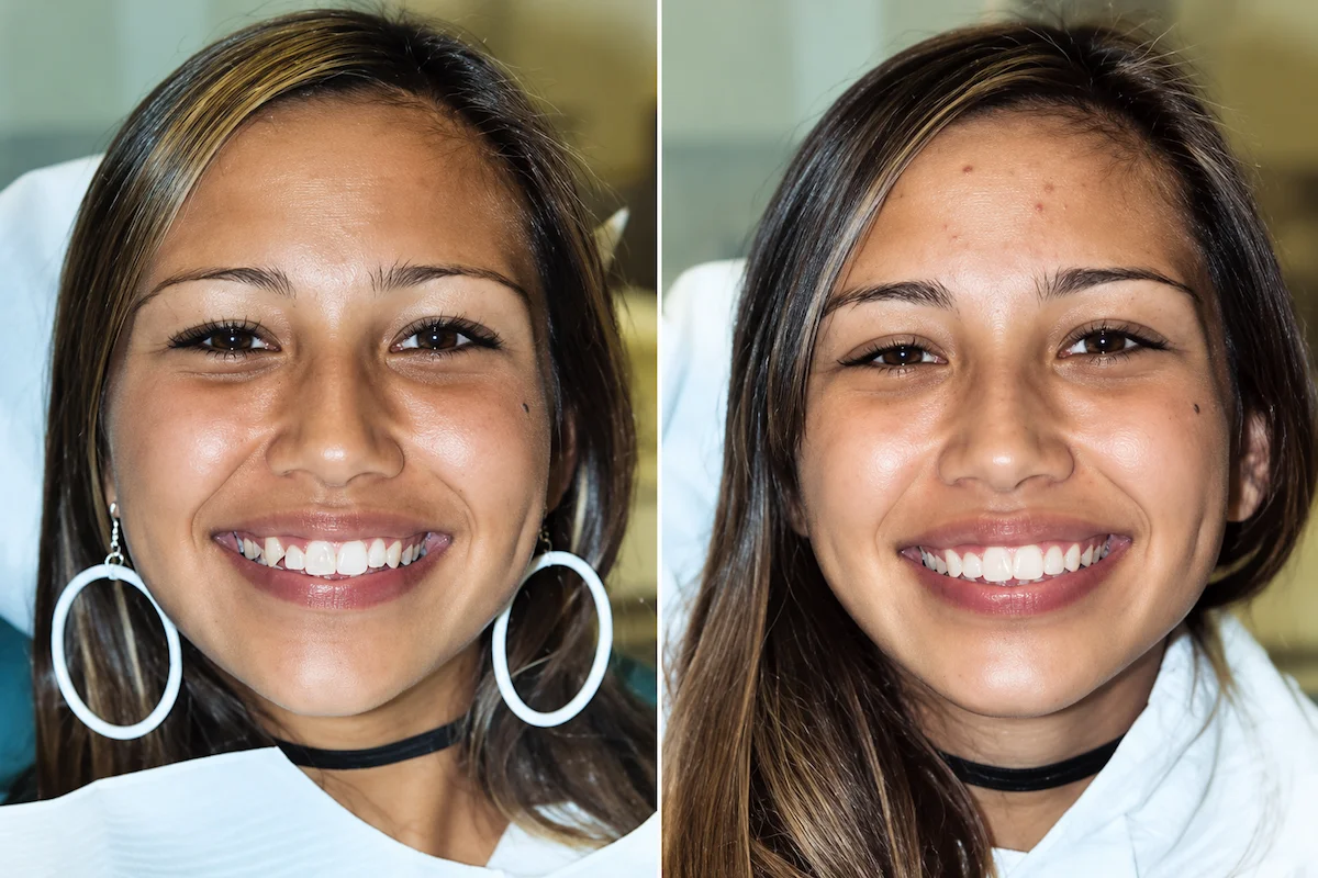 Before braces showing tooth alignment in Morton Grove, IL