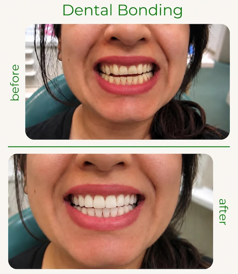 Before and after dental bonding showing improvement in tooth shape and smile appearance in Morton Grove, Illinois.
